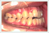 写真:受け口と開咬